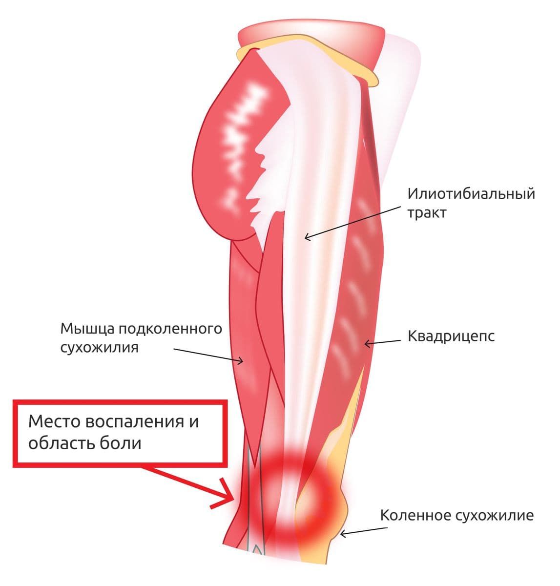 Синдром подвздошно-большеберцового (илиотибиального) тракта
